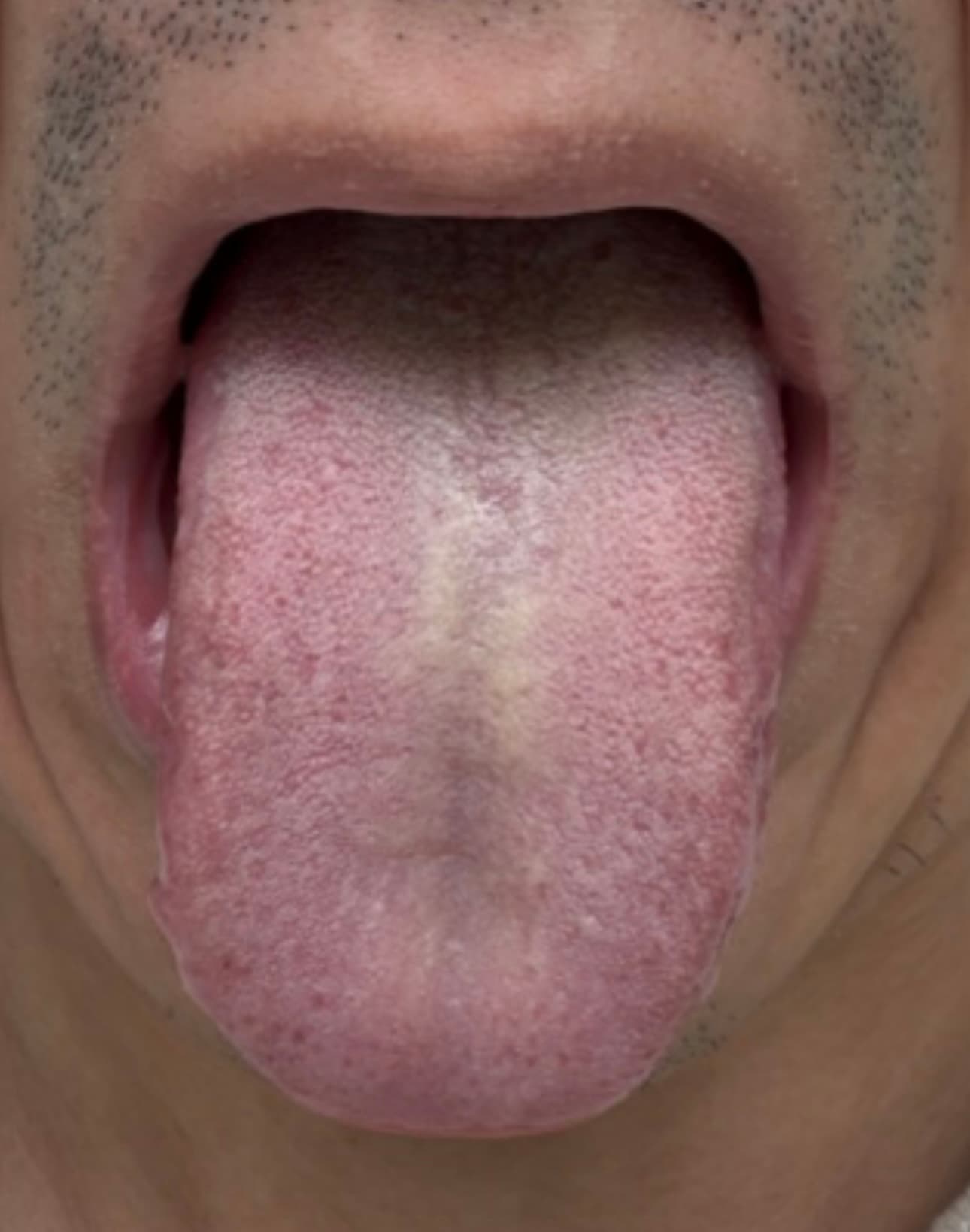 Tongue photo from a past consultation