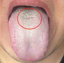 Tongue photo from a past consultation